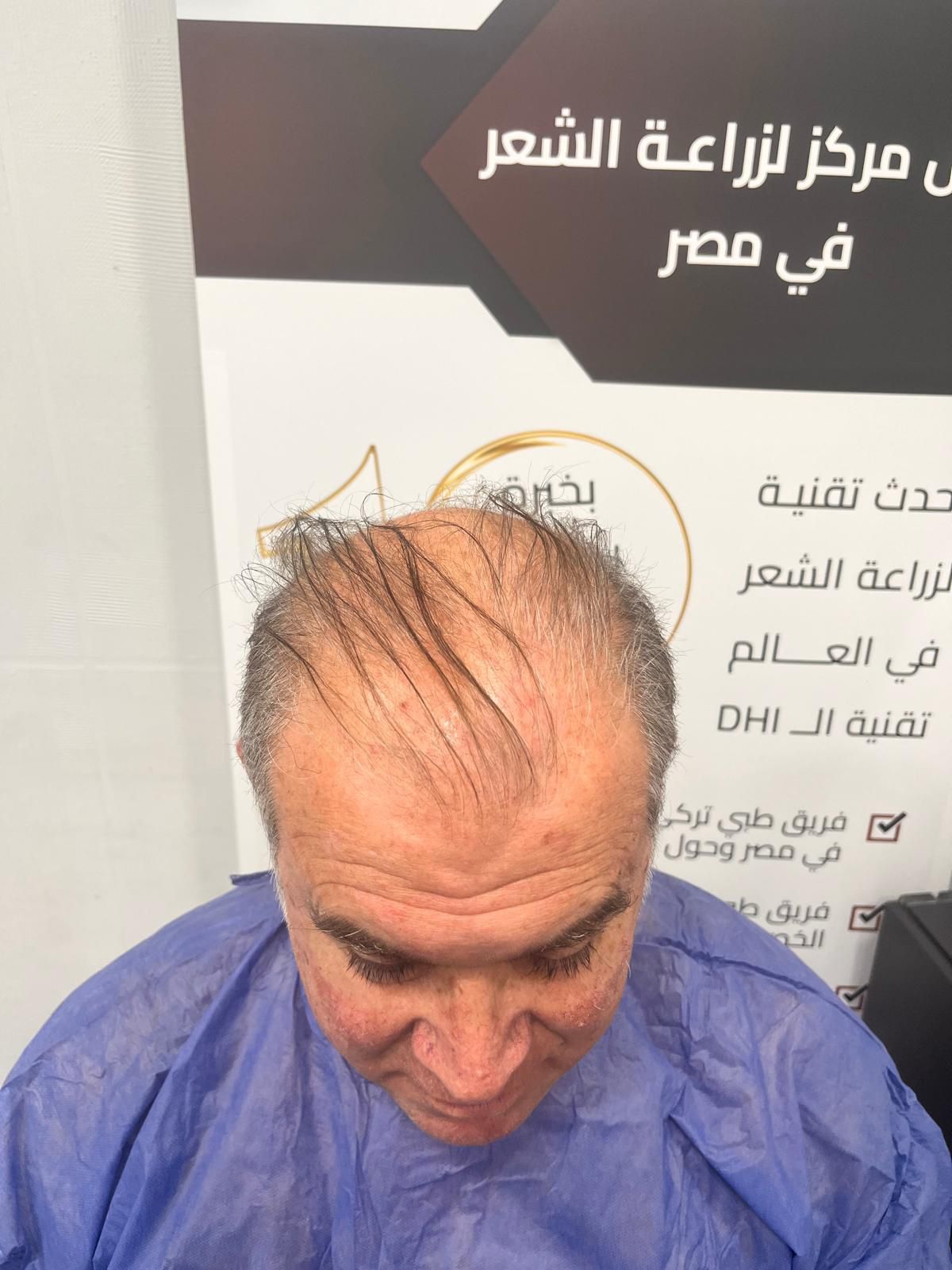 Before — علاج البلازما — تحسين كثافة الشعر